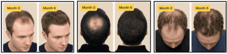 Keeps Topical Drop Before And After